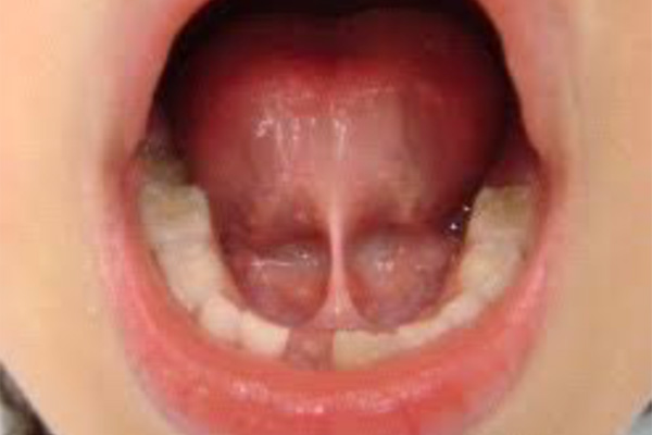 舌小帯/上唇小帯/頬小帯異常